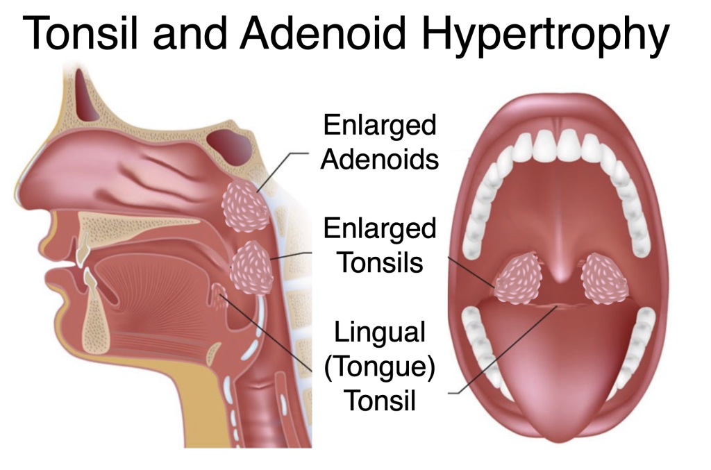 tonsil and adenoid hypertrophy - Dr Sivi Baktha