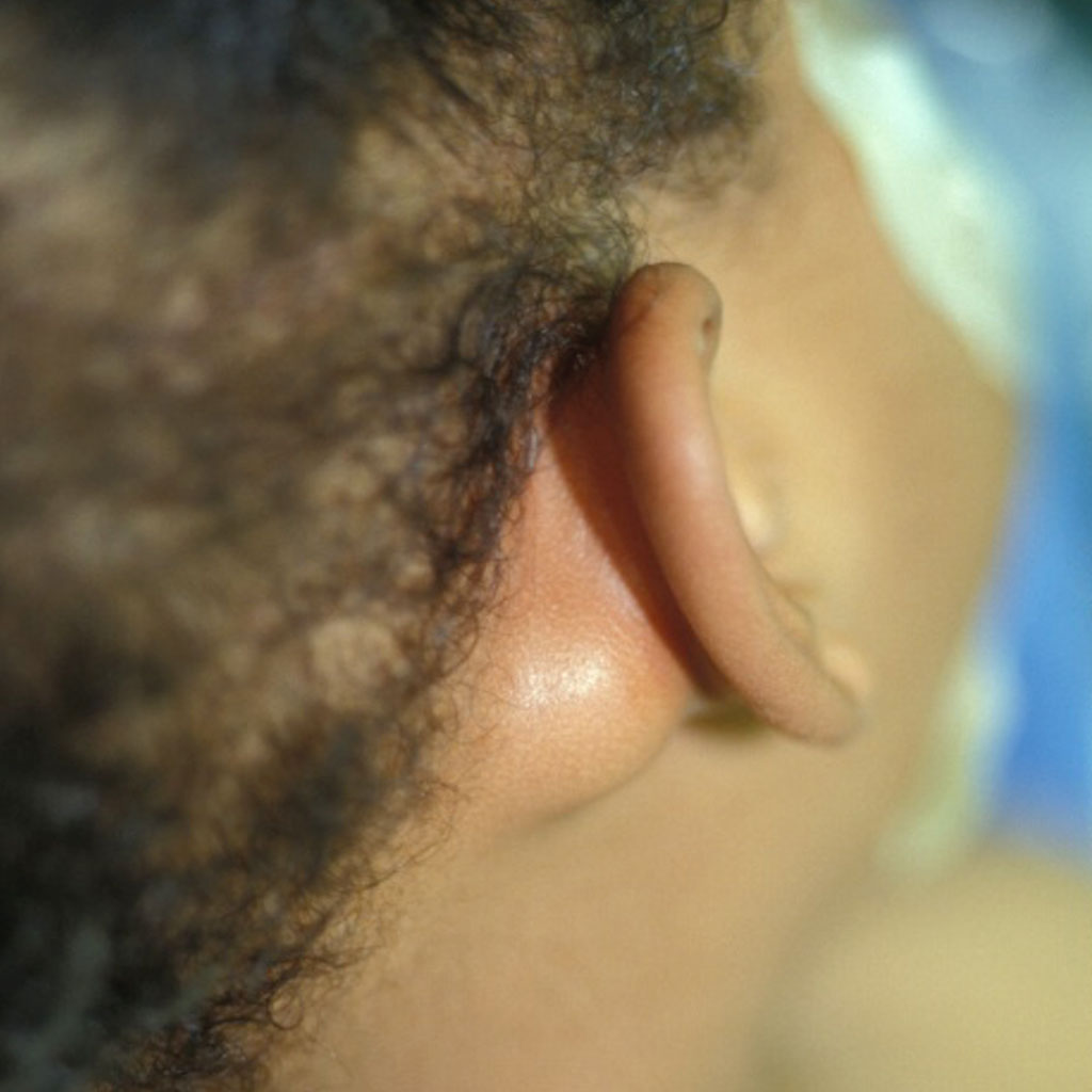 Type 1 First Branchial Cleft Cyst - Dr Sivi Baktha